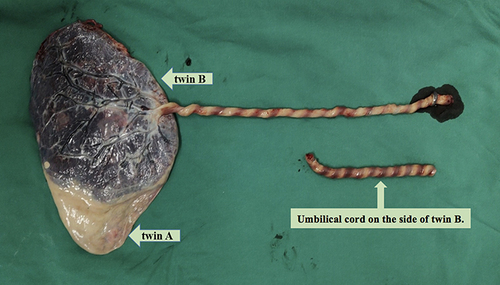 Figure 3 Images of the dichorionic diamniotic placenta and the umbilical cord of twin B.