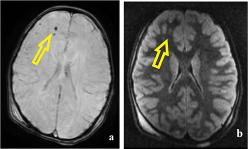 Figure 3 8-year-old girl, pedestrian involved in a motor vehicle accident. (a) In the white matter of the right frontal lobe- SWI and FLAIR imaging show small areas of low SWI signal (yellow arrow). (b) high FLAIR signal, consistent with frontal haemorrhagic DAIs (yellow arrow).