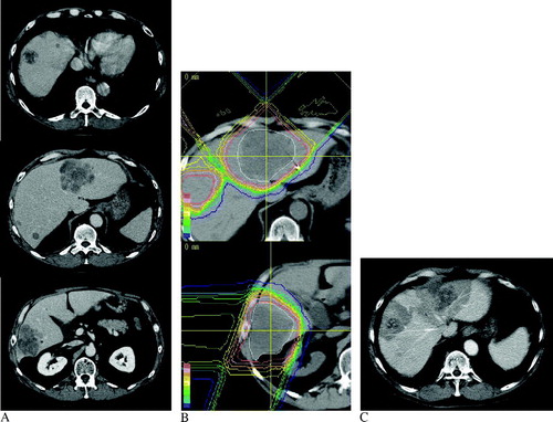 Figure 3.  CT images of Case 3. (A) Pre-treatment enhanced CT image with multiple metastatic tumors. (B) Dose distributions of the proton beam therapy for the largest three tumors. (C) The enhanced CT image at one month after proton beam therapy. The density of the irradiated liver tissue was low, unlike in Cases 1 and 2. This represented a different enhancement pattern of the radiation hepatitis Citation[15].