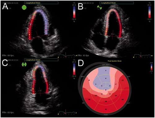 Figure 1. Speckle tracking strain analysis from day 1 after STEMI with culprit lesion in the left anterior descending coronary artery, displaying (A) peak systolic longitudinal strain in the apical long-axis view of −8.7%, (B) peak systolic longitudinal strain in the four-chamber view of −10.0%, (C) peak systolic longitudinal strain in the two-chamber view of −11.8%, and (D) the corresponding strain map with systolic strain values provided in each myocardial segment and with a parametric code, with strong red colors representing systolic shortening and blue colors depicting systolic lengthening of a segment. GLS was 10.2% in this patient. With permission from: Munk et al.[Citation18]