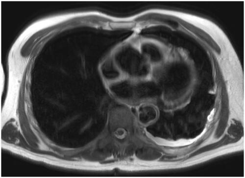 Figure 1. Axial MRI scan showing diffuse T2-weighted hyperintense tissue in the left pleural cavity (white intrapleural rim), extending to the left fissure and pericardium, being highly suspicious for pleural extension of previous peritoneal PMP.