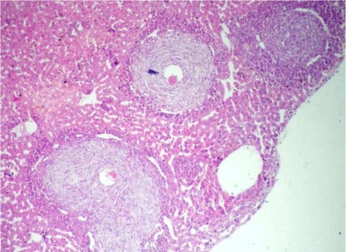 Figure 3 A liver section from a treated group showing one healed and two active hepatic schistosomal granulomas (H&E, ×40).