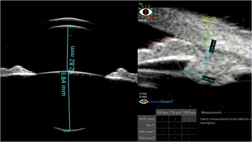 Figure 1 UBM image of one case, sulcus-to-sulcus axial scan (left), and lower quadrant radial scan (right), both are labeled with the measured parameters.