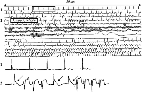 Figure 1. Single channel Holter recording during syncope showing normal ST segment (1) and ST segment elevation (2); during ST segment elevation severe ventricular arrhythmias were detected (transient ventricular tachycardia and fibrillation). The long sinus pause after VF termination is most probably due to sinus node dysfunction secondary to transient global ischemia.