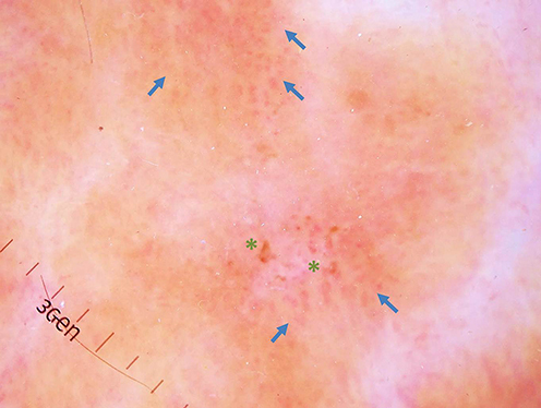 Figure 2 Dermoscopic features: dotted and globular vessels (blue arrows) over pinkish-white and brownish backgrounds with hemorrhagic crusts (green stars) (original magnification x20).