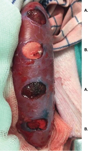 FIGURE 1 Examples of lesions in the porcine renal cortex, 10 mm in diameter and depth (created using a biopsy punch). Image taken after application of the hemostatic agents. A: lesions treated with gelatin–thrombin matrix with smooth particles (SmGM); B: lesions treated with gelatin–thrombin matrix with stellate particles (StGM).