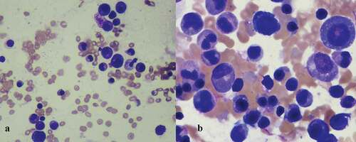 Figure 1. Bone marrow aspirate showing erythroid and myeloid precursors with vacuolization and megaloblastoid changes a: low power field, b: high power field