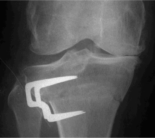 Figure 1. Closing‐wedge HTO. Opposite cortical fracture on the first day after surgery (radiograph in supine position).
