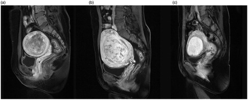 Figure 4. Contrast enhanced MRI from the patients with uterine fibroids. (a) Slight enhancement: the enhancement of the fibroid is less than that of the myometrium; (b) moderate enhancement: the enhancement of the fibroid is similar to the myometrium; (c) significant enhancement: the enhancement of the fibroid is greater than the myometrium.