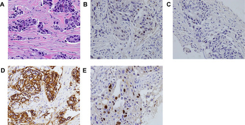 Figure 1 Pathological results of the breast. Haematoxylin–eosin (H&E) staining of biopsy samples (40×) magnification. (A) Immunohistochemical staining results of breast showed ER 10% (B) and PR 5% (C) and HER-2 2+ (D) and Ki-67 30% (E).