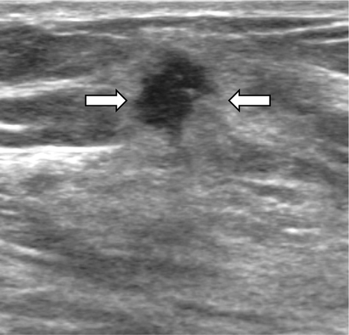 Figure 3.  A 44-year-old female with a grade 2 invasive ductal carcinoma. Ultrasound shows an irregular shaped, not circumscribed marginated, hypoechoic, not parallel orientated mass (arrows) with an echogenic halo boundary. The cancer was ER and PR positive, and HER-2/neu negative.