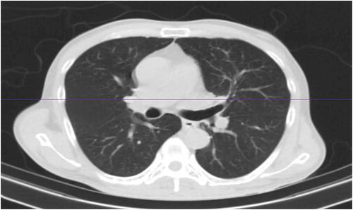 Figure 1. Chest CT scan- Axial view: Normal parenchymal lung tissue without evidence of active chest disease or intrathoracic lymphadenopathy.