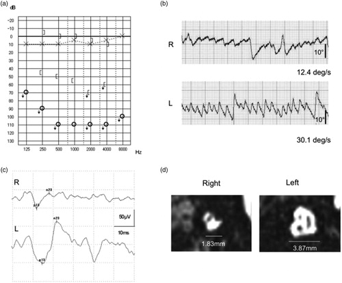 Figure 4. Case No. 17. Case No. 17 had profound hearing loss at all frequencies in the right ear. (a) Vestibular testing revealed hyporeflexia on caloric testing (b), and cVEMP results showed a decreased response (AR = 34.8%) (b). In the MR images of the sagittal IAC section, a narrow IAC (1.83mm in width) is seen in the affected ear and the cochlear nerve, vestibular nerve and facial nerve cannot be distinguish, while all nerves with a normal IAC width can be detected in the unaffected ear (b).