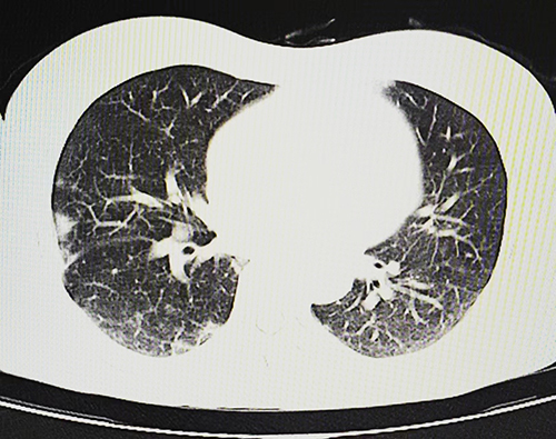 Figure 2 Patient’s chest CT report.