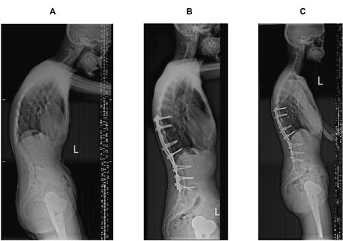 Figure 1 A 42-year-old female patient. (A) It shows the patient is allocated to the lumbar lordosis group before the operation. (B) Single segmental PSO surgery is performed at L1. The LL and SVA change to −59° and 38.26 mm from −24° and 148.73 mm, respectively. (C) During the follow-up, no obvious correction loss is observed in the final year.