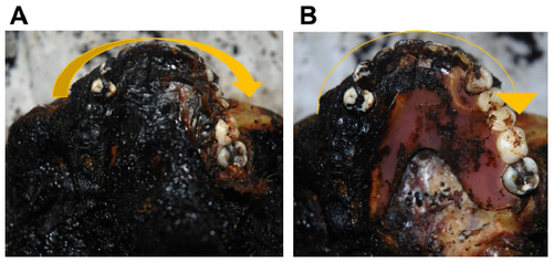 Figure 10 (A) The upper jaw with the denture before removing the soft tissues and (B) after removing the soft tissues.