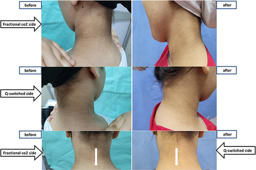 Figure 6 Patient 3 clinical photos before and after treatment.