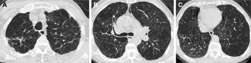 Figure 3 Extensive emphysema and mild bronchiectasis in case 3 with TB sequelae at RUL (HRCT).