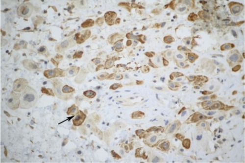 Figure 3 Immunohistochemical staining showed that the tumor cells were positive for human placental lactogen (hPL) (original magnification ×300). All the cells stained as claybank by 3,3’-diaminobenzidine chromagen (DAB).