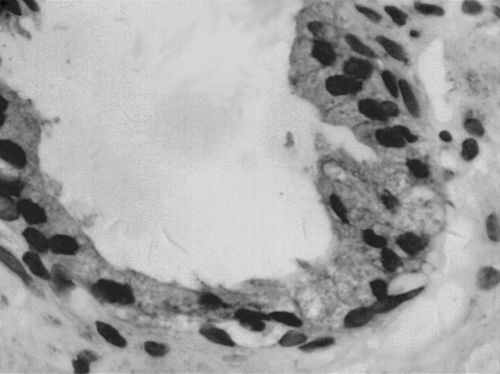 Figure 4 Expression of VEGF in BPH (SP, × 400) Staining intensity was detected in the cytoplasm.