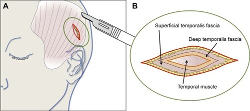 Figure 2 Schematic drawing of the surgical anatomy of the temporal scalp region.