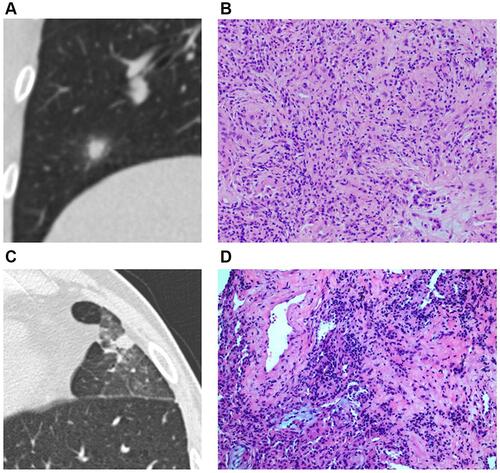 Figure 2 Solid SPINs with blurred margin (A) and peripheral patch (C) (type II). Pathologically, they have similar manifestations including more acute and chronic inflammatory cells infiltration and fibrous tissue proliferation (B and D).