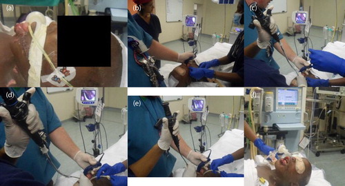 Figure 1: Sequence of exchange of an oral for a nasal ETT using a video laryngoscope and a flexible intubation scope (FIS). (a) Swollen tongue protruding beyond the teeth with drooling, predicting a probable difficult direct laryngoscopy. (b) Video laryngoscopy using a Glidescope (Verathon, Bothell, WA, USA/SSEM, RSA), which confirmed correct placement of the oral ETT. A paediatric airway exchange catheter (AEC) (Cook Medical, Wilmington, IN, USA/Marcus Medical, RSA) was advanced through a bronchoscope adapter into the oral ETT until the tip protruded into the bronchus by 2 cm. the AEC was seen on the Glidescope screen passing down the lumen of the ETT and the protrusion measured against the ETT measurements. (c) The replacement nasal ETT was loaded onto the AFIS, which was then introduced via the right nostril and advanced until the tip was seen on the Glidescope screen. (d) After a period of pre-oxygenation, the cuff was deflated and the oral ETT was withdrawn leaving the AEC in situ. The FIS was then advanced into the trachea whilst simultaneously watching the Glidescope screen, to lie alongside the AEC. (e) The nasal ETT was then railroaded over the FIS into the trachea as normal while watching the larger Glidescope screen. Tracheal rings could be seen via the FIS eyepiece, which also confirmed correct placement. The AEC was then removed, and the nasal ETT cuff inflated, and FIS removed. (f) The nasal ETT in situ with removal of both the oral ETT and gastric tubes.