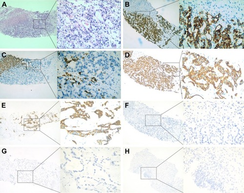 Figure 2 Pathologic evidence of intrahepatic cholangiocarcinoma (A ×100, ×400) showing adenocarcinoma infiltration of normal liver tissue. Immunohistochemical staining showed that CK 18, CK 19, CK 7, and Cox-2 were positive, while CDX 2, CK 20, Glypican 3, and Hep-1 were negative, which support adenocarcinoma from the intrahepatic bile duct (B, CK 19; C, Hep-1; D, CK 18; E, CK 7; F, Cox-2; G, CK 20; H, Glypican 3; ×100, ×400).