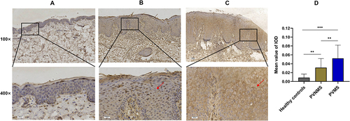 Figure 3 Expression of interleukin-9 receptor (IL-9R) in psoriasis vulgaris and normal human skin. Representative images of immunohistochemistry staining are shown for absent, weak, and strong expression of IL-9R in keratinocytes and inflammatory cells of normal skin ((A), n = 7), the skin of psoriasis vulgaris patients without metabolic syndrome (PVNMS) ((B), n = 30) and the skin of psoriasis vulgaris patients with MetS (PVMS), respectively ((C), n = 30). The red arrow indicates the positive expression of IL-9R in the cytomembrane of keratinocytes (Scale bar, 50 μm). The expression levels were quantitatively analyzed by Image-pro Plus (D). IOD, integrated optical density. Data are expressed as the mean ± SD. **P < 0.01, ***P < 0.001.