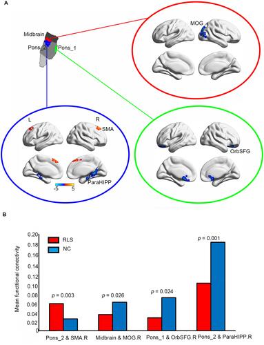 Figure 3 Altered functional connectivity patterns in patients with RLS compared to NC. (A) Brain regions which showed altered functional connectivity with midbrain (red), pons_1 (green), and pons_2 (blue) in patients with RLS. (B) The mean functional connectivity of altered brain regions in NC and RLS were compared using two sample t-tests.