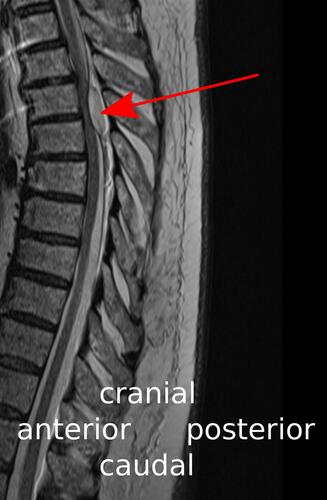 Figure 1 Midsagittal T2-weighted MR image showing the epidural hematoma (red arrow) with compression of the thoracic spinal cord at the level of the vertebral bodies Th4 and Th5.