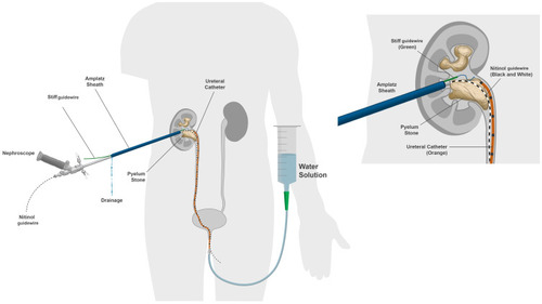 Figure 7 Irrigation solution that were pumped via the ureteral catheter increased the collecting system visualization and prevented stone fragments migration.