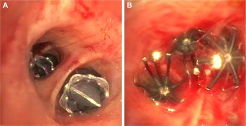 Figure 2 Different types of bronchial valves.