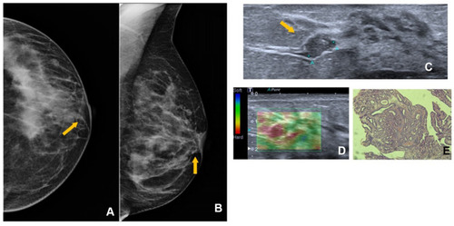 Figure 7 Left mammogram SDD (yellow arrow) at cranio-caudal (CC) (A) and medio-lateral oblique (MLO)(B) mammogram view. Targeted US shows intraductal mass (yellow arrow) (C) and high elastography (D); H&E staining (x10) shows sclerosing papilloma (E).