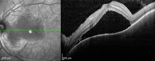 Figure 1 Optical coherence tomography of a 28-year-old male with Vogt-Koyanagi-Harada choroidopathy showing multilobulated serous retinal detachment involving the macula.