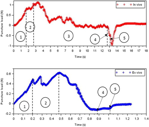 Figure 2. Typical curve for a successful PVCI, with remarkable steps.