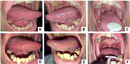 Figure 2 Intraoral appearances of the patient in Case 2 (A–C) On the first examination, there was a single erythematous lesion, yellowish-white plaque that could not be scrapped, reddish-yellow single ulcer, and corrugated white plaque that could not be scrapped (D–F) The lesions resolved after 14 days.