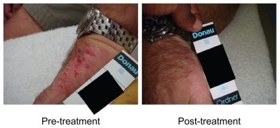 Figure 1 Photograph of patient before and after treatment.