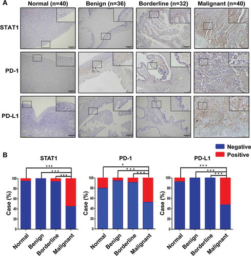 Figure 1. Immunohistochemical staining of STAT1, PD-1, and PD-L1 proteins and case rate of positive staining. (a) Expression of STAT1, PD-1, and PD-L1 proteins in normal ovarian tissues and epithelium-type ovarian tumors. An enlarged image was inserted in the up-right corner of the picture. A brown color in epithelial cells is considered positive staining. Representative images of STAT1, PD-1, and PD-L1 expression are shown. Original magnification × 100. Scale bar 200 µm. (b) The case rate of STAT1, P-D1, and PD-L1 positive and negative staining. The ratio of positive/negative was 2/38, 8/32, and 3/37 for STAT1, PD-1, and PD-L1, respectively, in control without tumor (40 cases); 0/36, 2/34, and 0/36 for STAT1, PD-1, and PD-L1, respectively, in the benign tumor (36 cases); 2/30, 3/29, and 0/32 for STAT1, PD-1, and PD-L1, respectively, in the borderline tumor (32 cases); 22/18, 19/21, and 21/19 for STAT1, PD-1, and PD-L1, respectively, in the malignant tumor (40 cases). For comparison between the two groups, the χ2 test was applied. Normal, normal ovarian tissue; Benign, benign tumor; Borderline, borderline tumor; Malignant, malignant tumor. *, P < .05; ***, P < .001