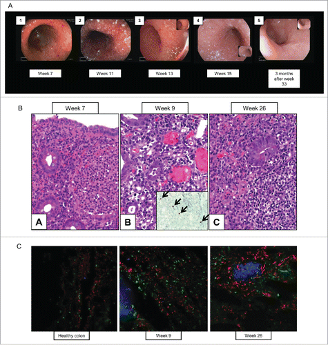 Figure 2. (A) High-definition endoscopy. Pictures 1–4 of weeks 7, 11, 13, and 15 describe both in high definition white-light (3, 4) and in virtual chromoendoscopy (1, 2) an erythematous, granulomatous and oedematous mucosal inflammation of the rectosigmoid colon with a high mucosal vulnerability (spontaneous diffuse mucosal bleeding). Images 2 and 4 show a particular grainy white pattern suggesting an overlapped infectious origin confirmed by immunohistochemistry and microbiology as a CMV colitis which superposed and complicated the initial autoimmune T cell driven ipilimumab colitis. As a comparison, picture 5 taken 3 mo after week 33 shows an almost complete mucosal restitution with reminiscent erythema, hypervascularity and healed scars in the colon. (B) Immunohistochemistry of colon biopsies with CMV staining. [A]: pre-CMV initial biopsy showed prominent plasma cell-rich inflammatory infiltrates in the lamina propria and notable crypt abscess formation. [B]: CMV-stage: the crypt epithelium showed regenerative changes with large intranuclear inclusions, the lamina propria contained mixed infiltrates with prominent dilated capillaries. Inset: CMV was strongly positive in four nuclei in this field (arrows). [C]: post-CMV biopsy showed still prominent mononuclear cell infiltration but no neutrophilic crypt abscesses, note follicular hyperplasia. (C) Multi-epitope ligand cartography (MELC) of cryo-conserved colon tissue. Samples taken at two different time points and a control sample from healthy colon have been stained for different antibodies using the MELC-technique.Citation19 Natural killer cells (CD56+) and CTLA-4 positive cells increased over time, and B cells (CD20+), CD8+ T-cells, memory T cells (CD45RO+) and CD45+ T cells additionally formed follicles. Depicted is an overlay (20X magnification) of NK cells (red), CD8+ T cells (green) and B cells (blue).