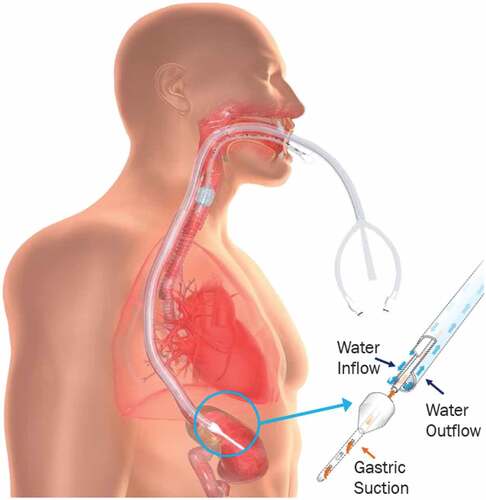 Figure 1. Diagram of active esophageal cooling device (external heat exchanger not shown). Placement of the device in the esophagus is done analogously to a standard orogastric tube. Once placed, the temperature of the water flowing through the device can be reduced to a temperature of 4°C, effectively maintaining the esophageal wall opposite the posterior wall of the left atrium at a temperature below the lethal isotherm of tissue while radiofrequency ablation is successfully applied to form the intended lesions in the left atrium.