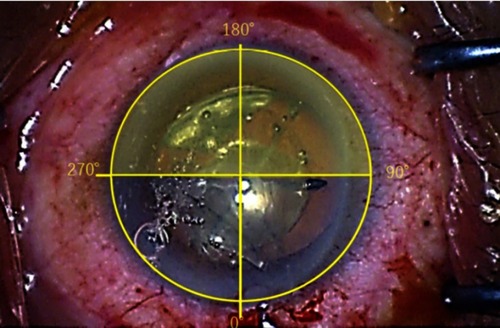 Figure 8 Image of the zonular dehiscence area from 90° to 270° (yellow shadow area).