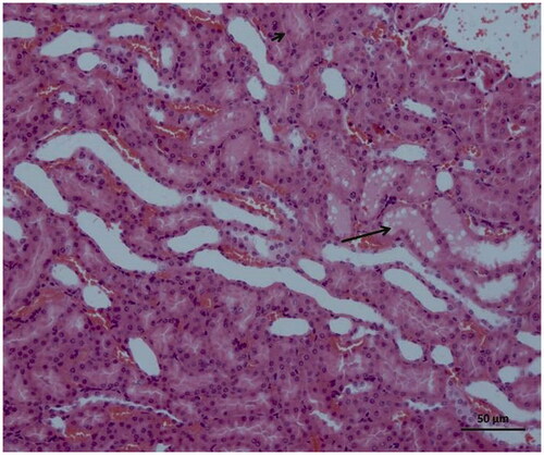 Figure 6. Histopathological results showing swelling in tubular epithelial cells (short arrow) and accumulation of proteinous material (arrow) in some tubule lumens in rats treated with I/R + 15 mg/kg desloratadine.