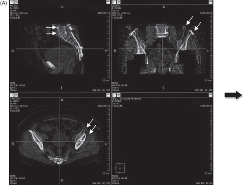 Figure 2. Pre- and postoperative CT reconstruction views (white arrows) were interposed automatically using 3D viewer software. (A) Before interposition. (B) After interposition. This procedure can change the postoperative pelvic position into the planned pelvic coordinates.