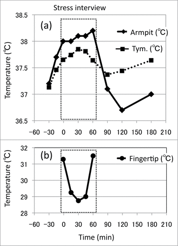 Figure 6. Effects of stress interview on core and peripheral temperatures in a 26-year-old CFS patient. Changes in axillary (armpit) and tympanic membrane (tym.) temperatures (A) and fingertip temperature (B) during and after a 60-minute stress interview. Stress interview was conducted for one hour (0 min – 60 min). © BioMed Central. Reproduced by permission of BioMed Central. Permission to reuse must be obtained from the rightsholder.