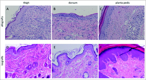 Figure 1. Histopathologic characteristics and immune cell distribution in the skin of the thigh, dorsum and planta pedis of limb allografts and isografts on POD 5. (A) (thigh), (B) (dorsum), and (C) (planta pedis) depict a Banff grade II rejection in allograft skin on POD 5, however, the extent of the cell infiltrate and cell distribution varied between the sampling spots. In general, the diffuse dermal cell infiltrate was more prominent in the thigh (A), compared to the dorsum (B). An interface reaction and dermal involvement with migrated immune cells was found at both sampling spots, but with a focal restriction in the dorsum (B). In the planta pedis the cell infiltrate was very prominent in the perivascular areas, but epidermal involvement with epidermal immune cell migration was found as well, which is per definition a grade II rejection. In isograft skin only a mild dermal cell infiltrate (D) (thigh) or no signs of inflammation (E) (dorsum) and (F) (planta pedis) were found on POD 5.