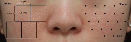 Figure 1 Protocol of the combined treatment with micro-focused ultrasound with visualization (MFU-V) and intradermal incobotulinumtoxin-A (INCO). Both anterior cheeks were divided into four square areas of 2.5×2.5 cm2. First, MFU-V treatment was administered by 25 treatment lines per square using a 10-MHz/1.5 mm transducer. Then, 2.5 U of diluted INCO was intradermally injected in each square. In total, 100 lines of MFU-V and 10 U of INCO were administered on each cheek.