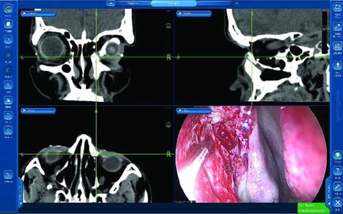Figure 7 Case 3: Intraoperative active localization of the lacrimal apparatus following the osteotomy.