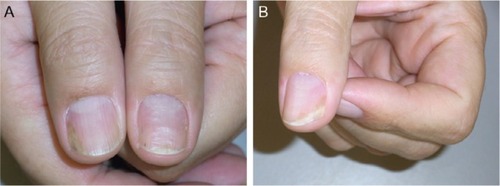 Figure 3 As topical and injection treatments are insufficient and inconvenient, systemic methotrexate is instituted.