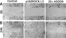 Figure 4 Wound assay analysis of p160ROCKΔ3 mutant and anti-p160ROCK oligos on the migrating activity of Caov-3 cells. A, control example representing transfectants with p160ROCK SODN, pCAG-myc vector and LipofectAMIN2000. B, cells transfected with p160ROCKΔ3. C, cells transfected with ASODN against p160ROCK (20 μ M). Wounds were created with a sterile tip in 90% confluent monolayers of cells (see Materials and Methods). The monolayers were cultured for 24 h in DMEM. Movement of the cells into the scarred region resulted in a decrease in the surface area of scar. Scale bar = 300 μ m.